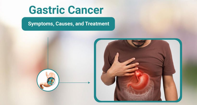 Gastric Cancer Symptoms, Causes, and Treatment